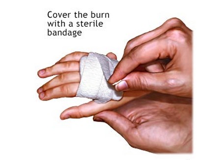 Cover_burn_with_sterile_bandage