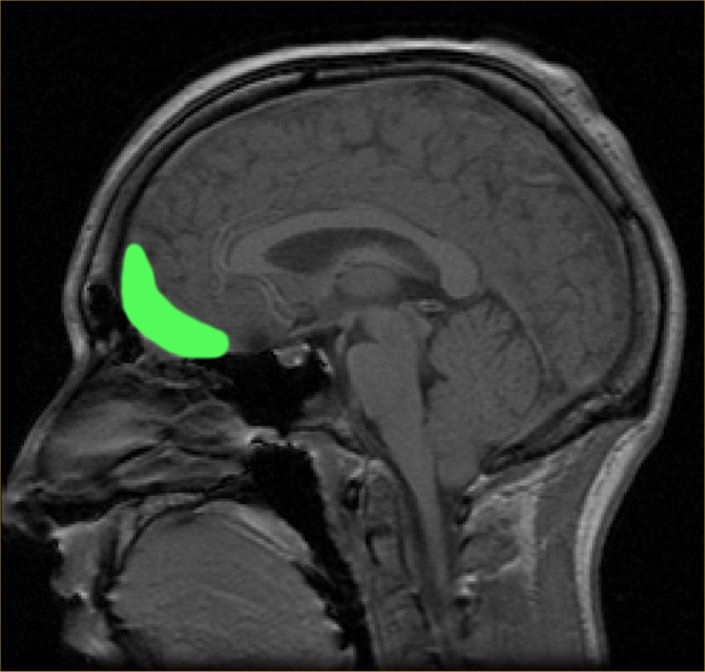 sagittal section of brain