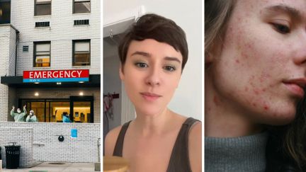emergency room (l) woman shares pimple experience (c) acne on face (r)