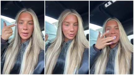 TikTok turns against servers wearing under-eye and pimple patches to work.