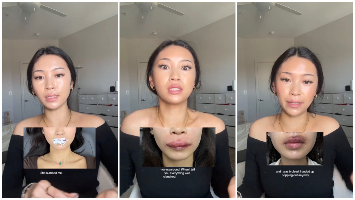 NYC woman gets lip filler for the first time for her birthday and rushes back to the doctor three hours later: ‘I should have never touched my face’
