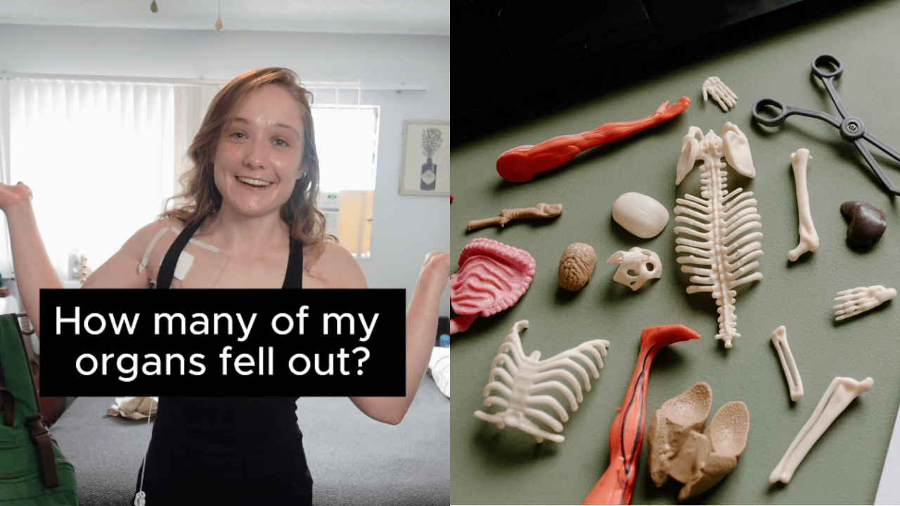 Her pelvic floor collapsed. Now her organs are ‘serial escapees’ that keep falling out of her body