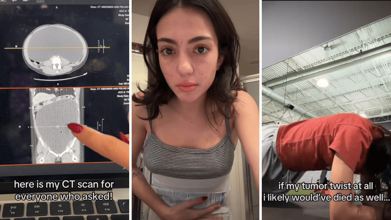 Woman told to lose weight until they found a cyst in her ovary. It grew to 18 pounds: 'Honestly, I think I'm some kind of superhuman'